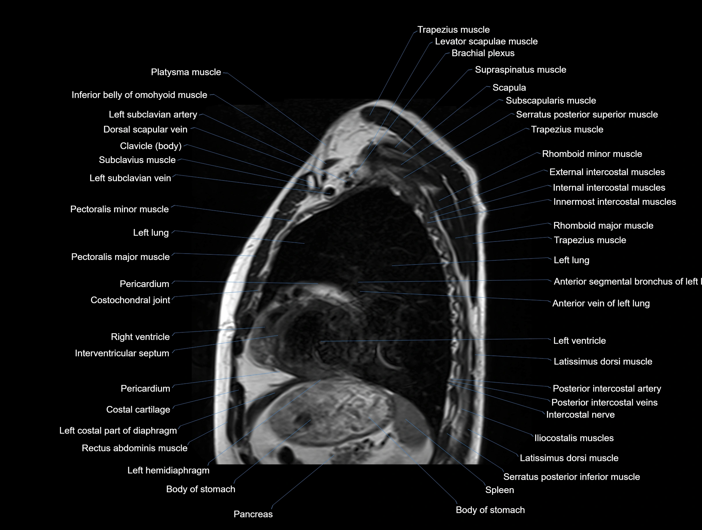MRI chest (thorax) coronal  cross sectional anatomy 3T radiology  image-img-00001-00027.webp